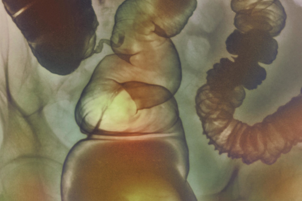 An X-ray image of irritable bowel disease (IBD)